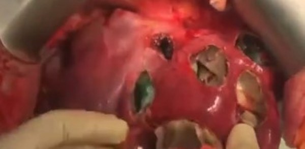 Uzmanlardan Uyarı: “Peynir gibi delik deşik”